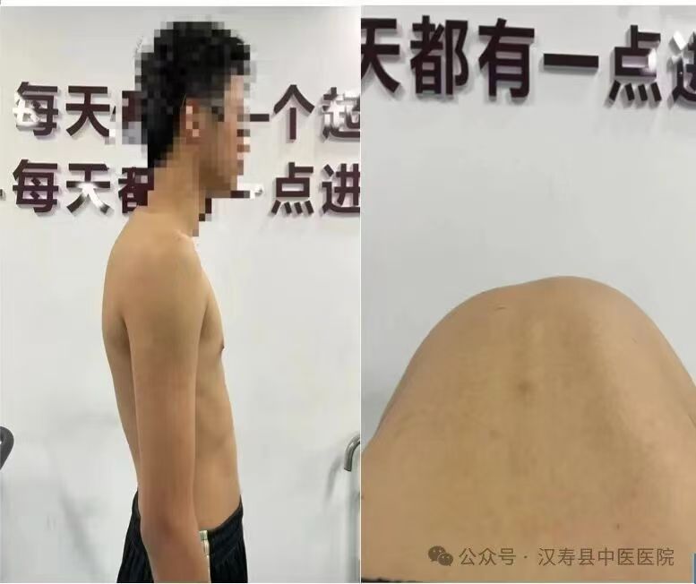 汉寿县中医医院针灸理疗康复中心青少年脊柱侧弯体态不良暑假训练营开始招生啦！